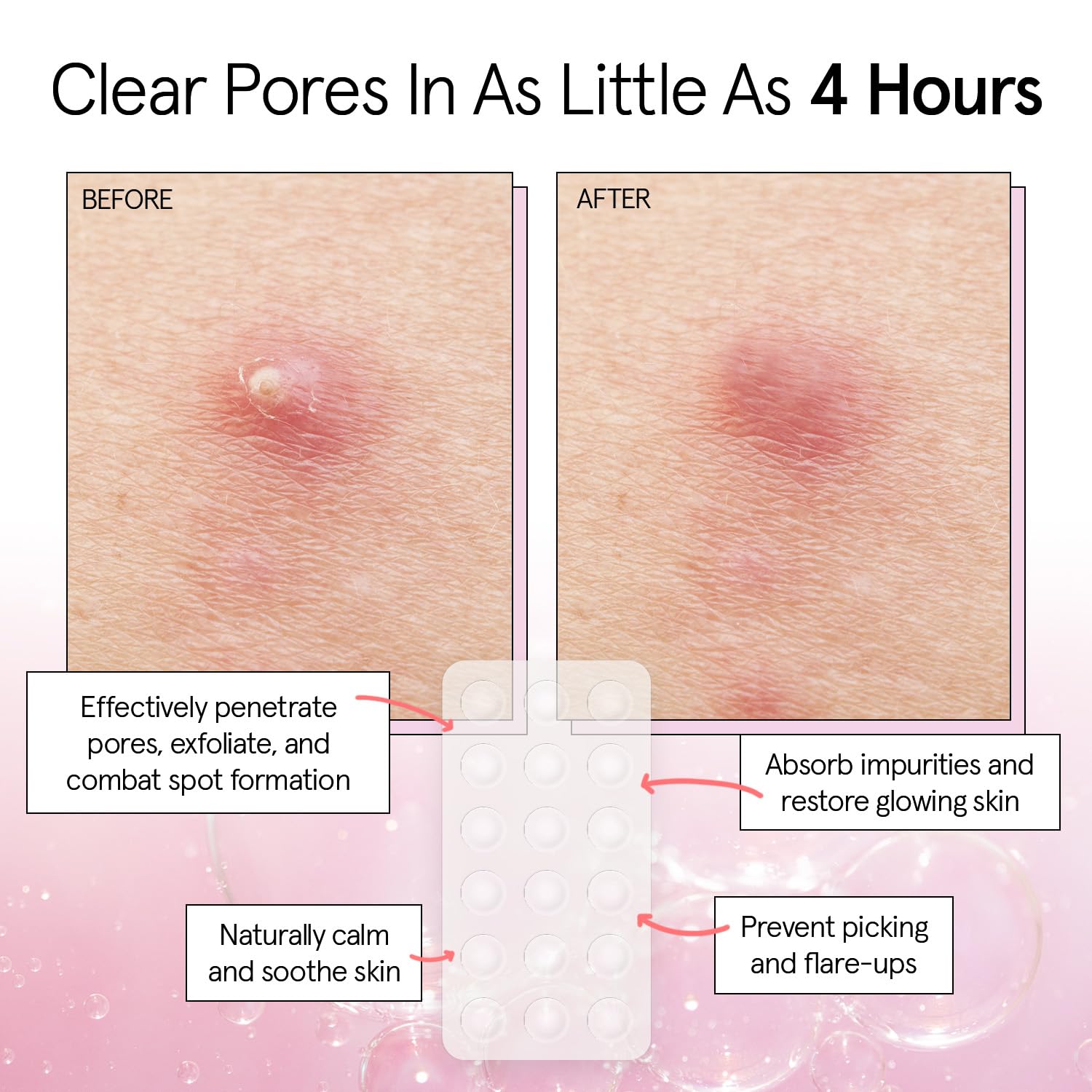 Alternative view of grace & stella Award Winning Pore Strip - Pimple Patches for Face - Hydrocolloid Acne Patches for Shrinking Zits, Breakouts - Spot Stickers - Dermatologist-Tested, Vegan (Invisible, 36 Count)